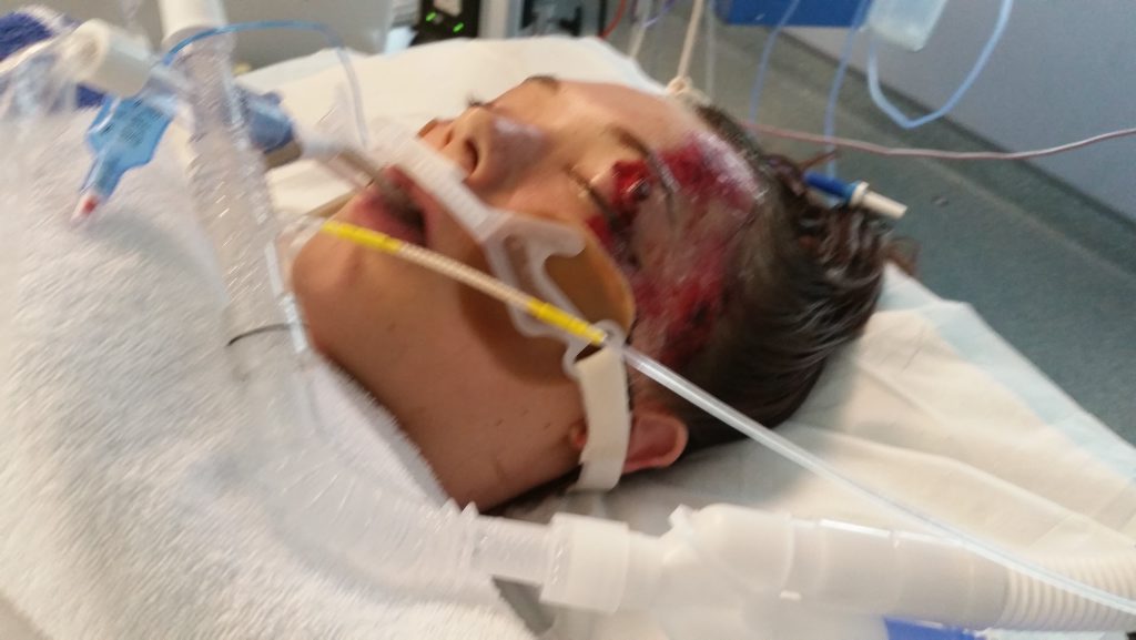 Kintara Andrews is now recovering 12 months after beening hit by a car crossing the Bruce Highway, Gympie.CONTRIBUTED Kintara Andrews is now recovering 12 months after beening hit by a car crossing the Bruce Highway, Gympie.CONTRIBUTED
