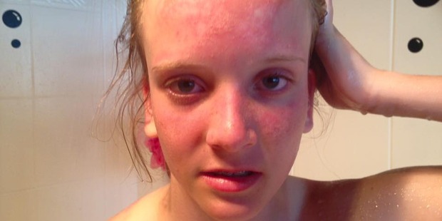 Manda Sharp posted a photograph of her burnt and blistered face, saying: Manda Sharp posted a photograph of her burnt and blistered face, saying: