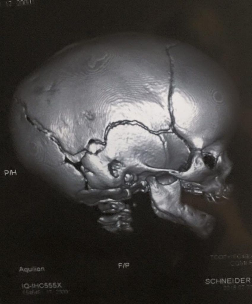 Scan image of Laythen Schneider's skull before surgery Photo: Contributed Scan image of Laythen Schneider's skull before surgery Photo: Contributed