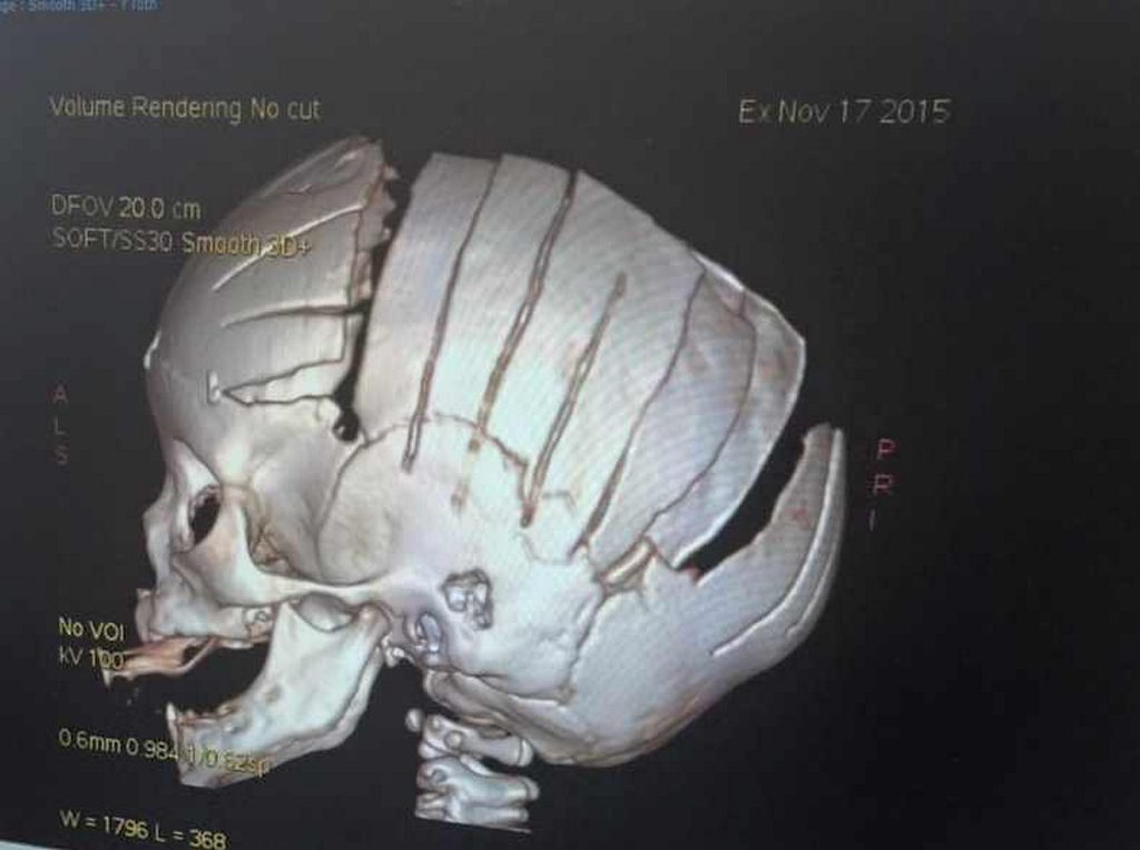 Scan image of Laythen Schneider's skull after surgery Photo: Contributed Scan image of Laythen Schneider's skull after surgery Photo: Contributed