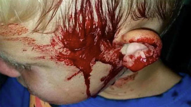 Tyler was bitten on the face and finger. Tyler was bitten on the face and finger.
