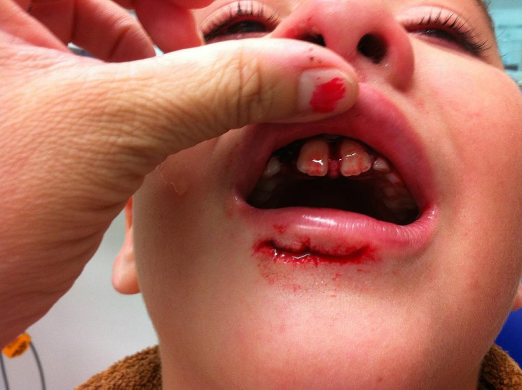 Bailey with his split lip. Bailey with his split lip.