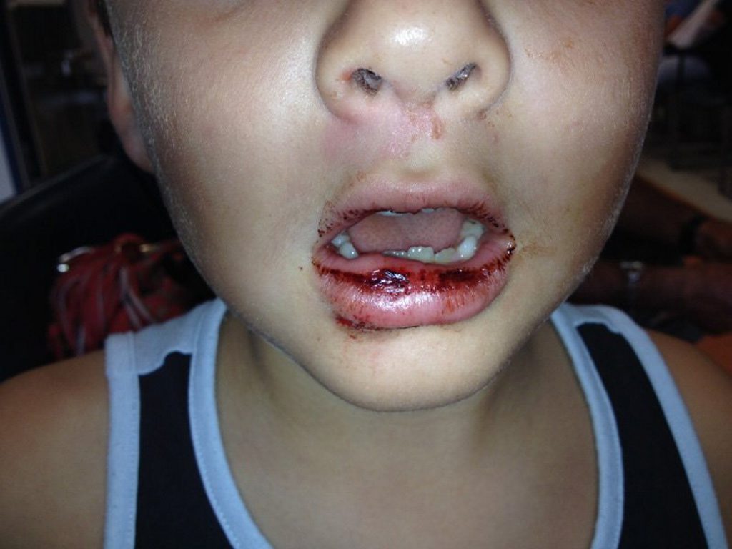 Bailey with his split lip. Bailey with his split lip.