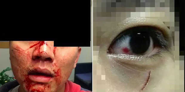 Victims of serious assaults on Asian students in Auckland. Victims of serious assaults on Asian students in Auckland.