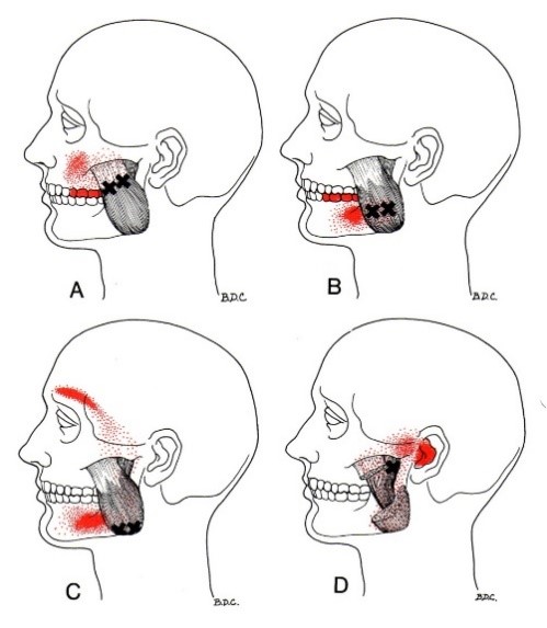 A map of pain patterns referring from your jaw and associated muscles. A map of pain patterns referring from your jaw and associated muscles.