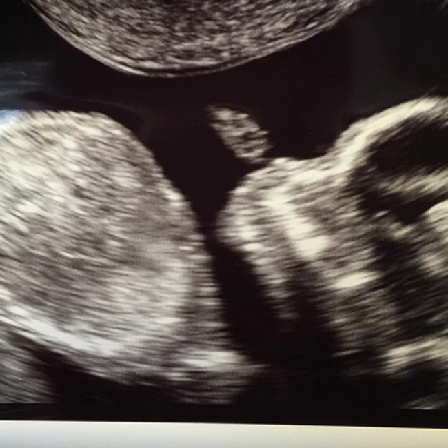A pitcure of the ultrasound Blac-Chyna shared A pitcure of the ultrasound Blac-Chyna shared