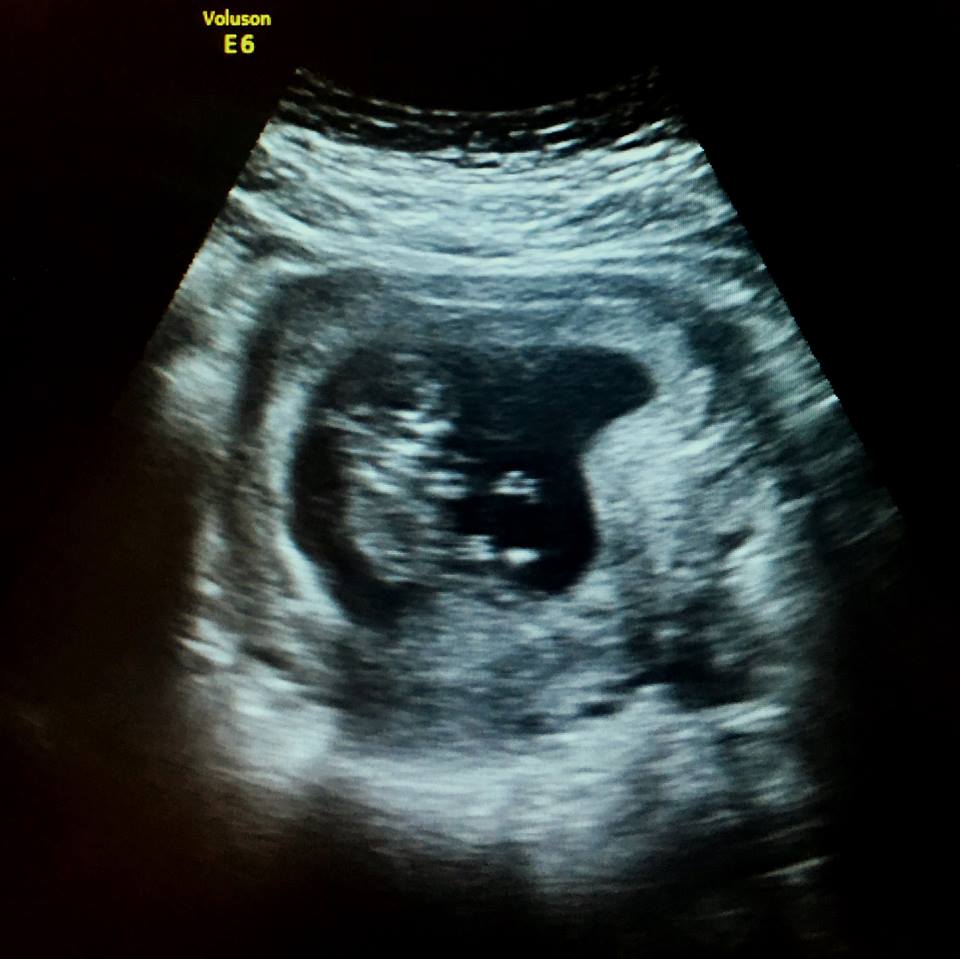 Dan and Leah are pregnant. Dan and Leah are pregnant.