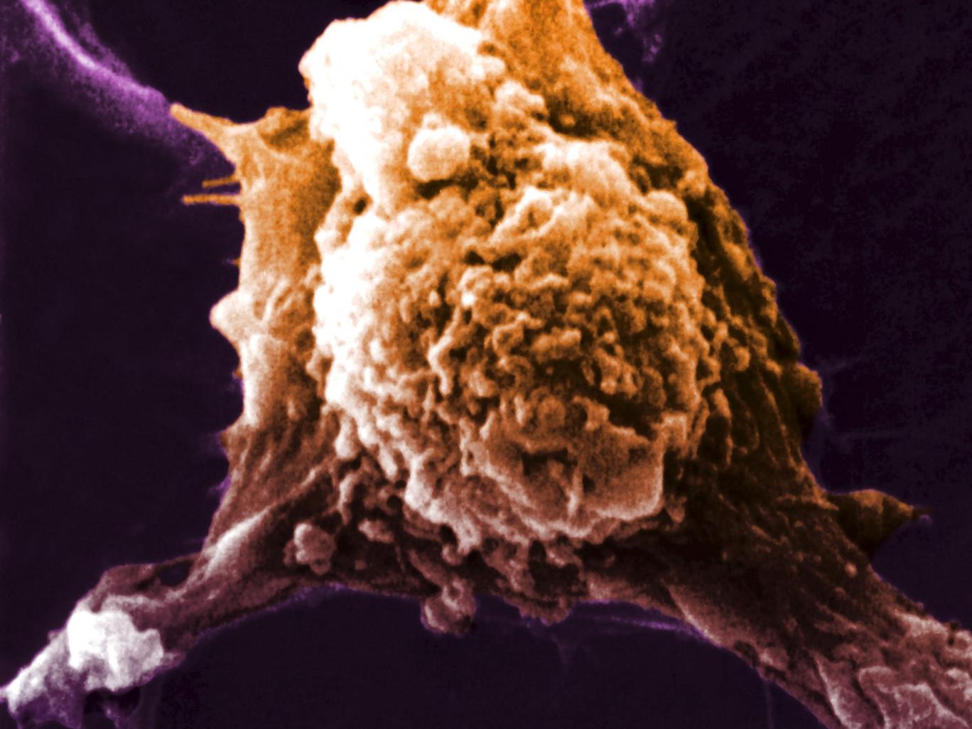 QUEENSLAND has the highest rates of cancer in Australia QUEENSLAND has the highest rates of cancer in Australia