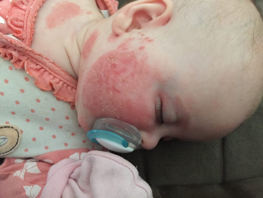 A flare up of baby Kelsey's eczema before she started her current treatment. A flare up of baby Kelsey's eczema before she started her current treatment.