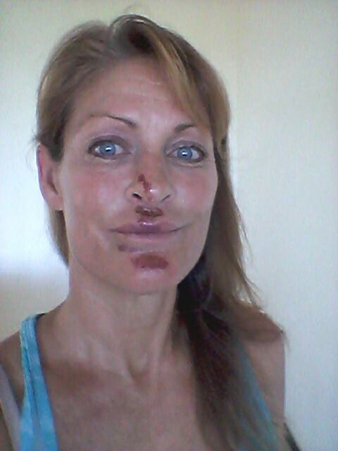 Balinese expatriate Maya Wolford showing the injuries she suffered after she says she was drugged in an Echo Beach bar. Balinese expatriate Maya Wolford showing the injuries she suffered after she says she was drugged in an Echo Beach bar.
