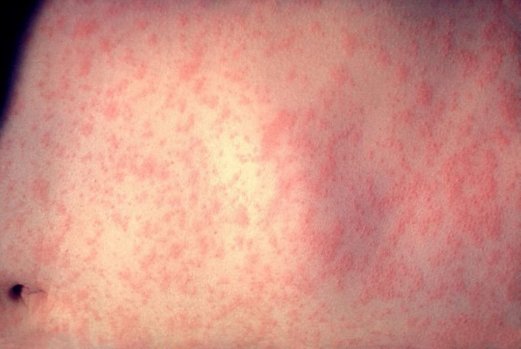 A measles infection. A measles infection.