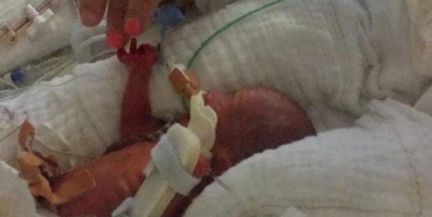 Billie Ava Stevens came into the world at just 25 weeks and weighed just 510 grams. Billie Ava Stevens came into the world at just 25 weeks and weighed just 510 grams.