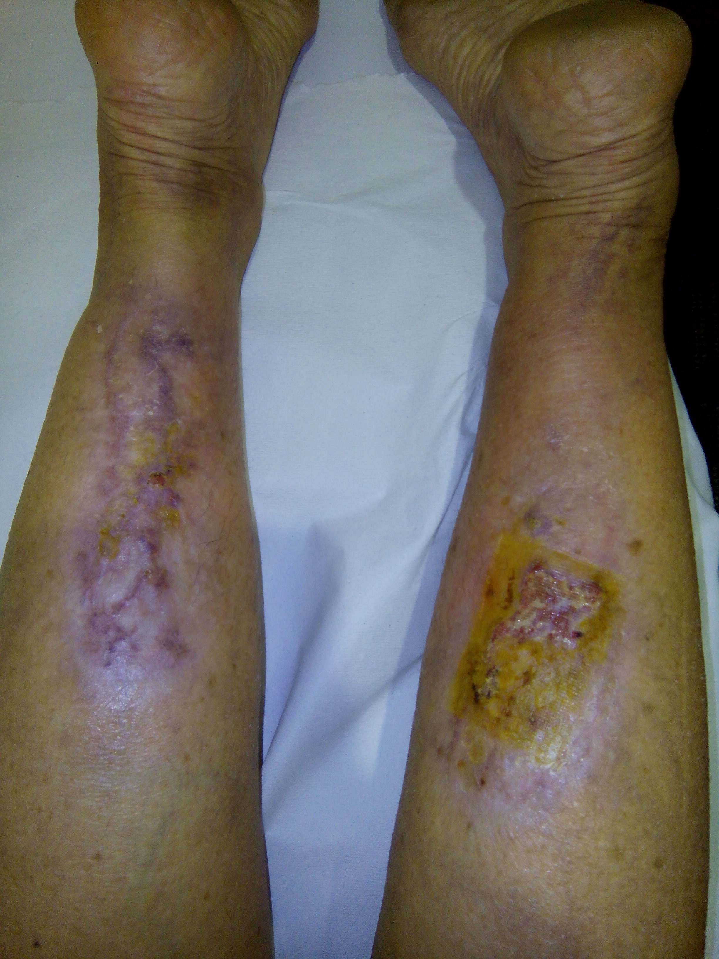 My legs after seven months of treatment and healing